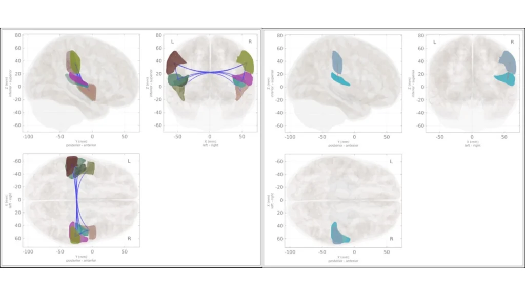 MRI brain with colored fiber tracts and region labels shown in multiple views across left and right hemispheres. (tractography visualization)